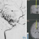 Minimally invasive keyhole surgery under neuronavigation